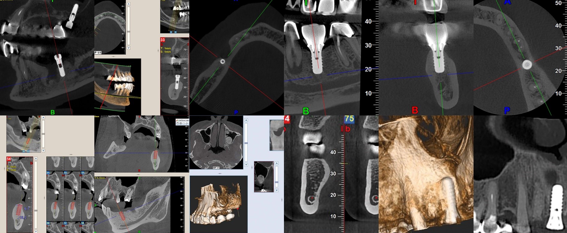 3D CBCT