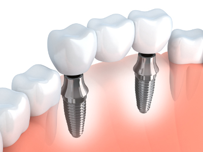 Zubní implantáty